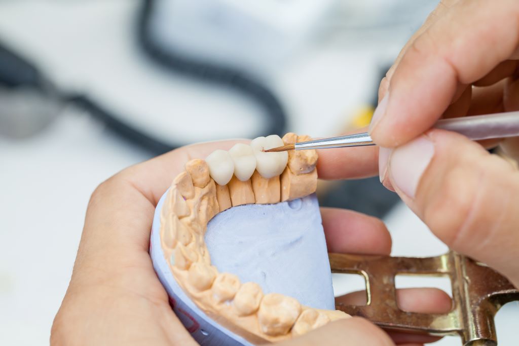 Dental Bridges & Crowns in Ambleside Near Windermere