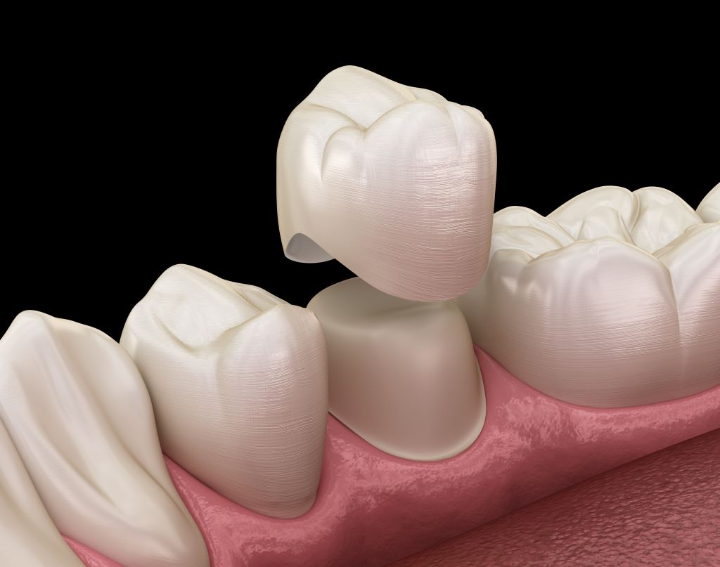 Dental Bridges and Crowns Near You