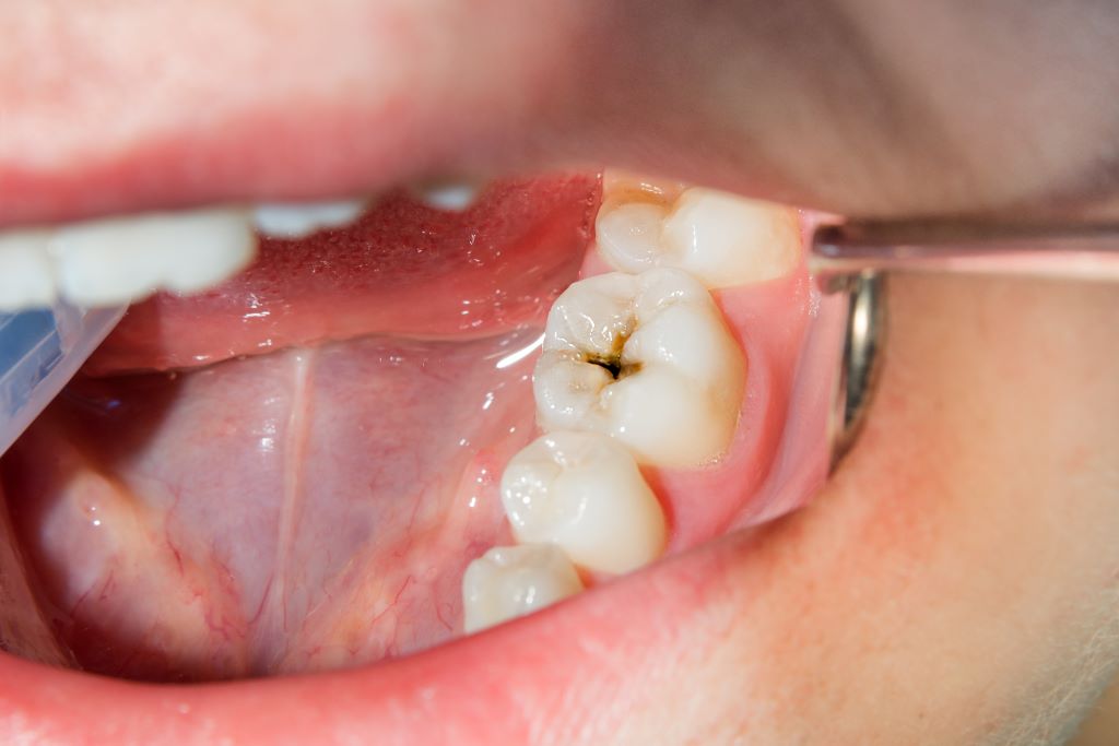 Dental Fillings in Ambleside Near Windermere