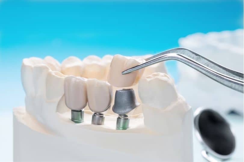 Taking Care of Your Dental Implants: Easy Tips