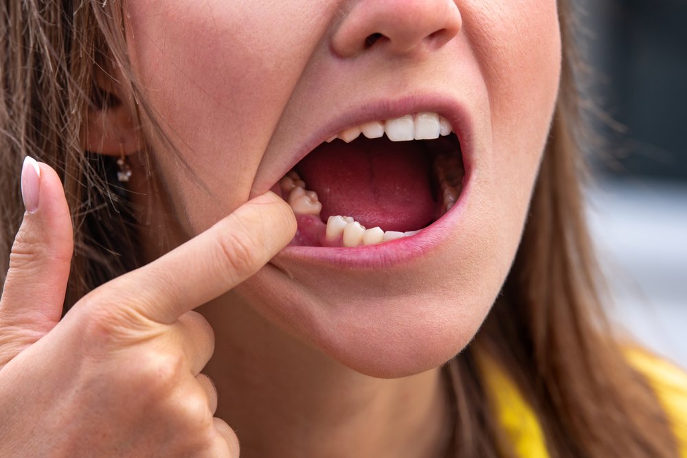 back tooth replacement