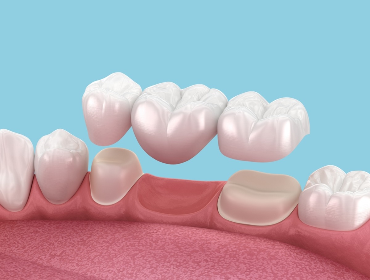 dental bridge support tooth damage